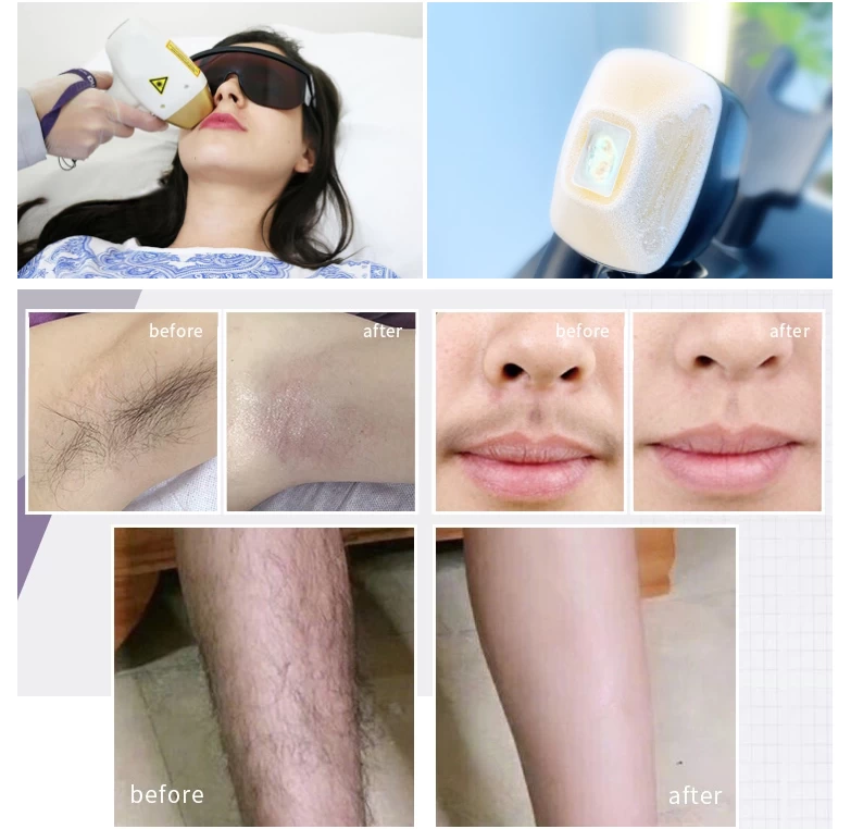 4K Screen Diode Laser 3 wavelengths 755 808 1064 Diode Laser hair removal machine with CE