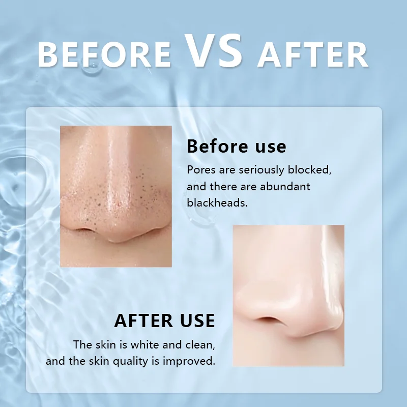 RF RED light Blackhead Remover