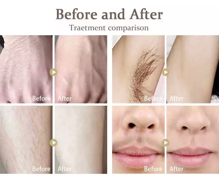 Germany bars permanent laser hair removal diode laser 755 808 1064 3 in 1
