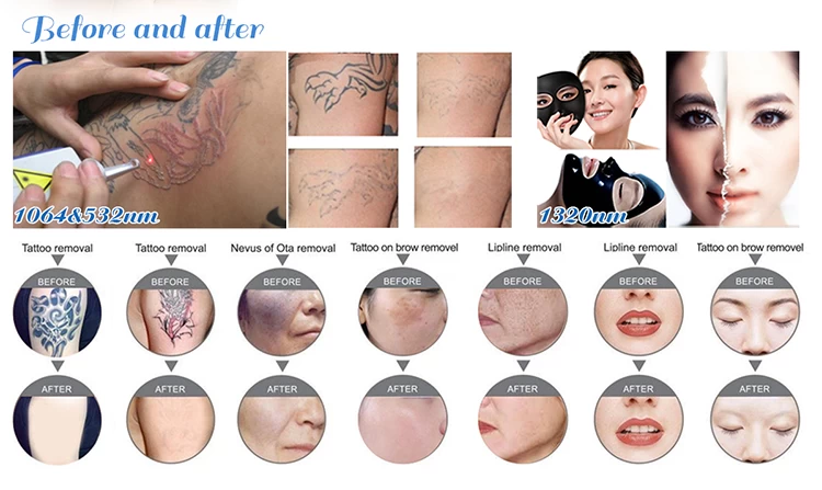 Hot sale picolaser pico laser tattoo removal freckle removal spot removal machine