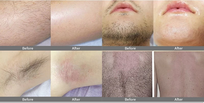 On sale! FDA approved medical painless and permanent clinical hair removal treatment machine