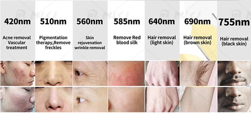 Freckles pigment age spots removal beauty machine ipl hair laser removal device