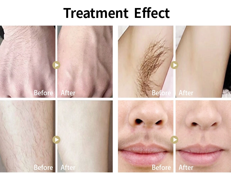 Professional laser machine hair removal depilation diode ice laser 808 diod laser 808 808nm hair removal