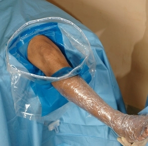 Knee Drape Pack, Knee set, Knee Drape,Arthroscopy Pack